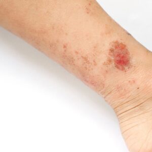 Leg with eczema
