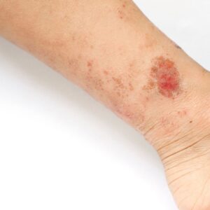Leg with eczema